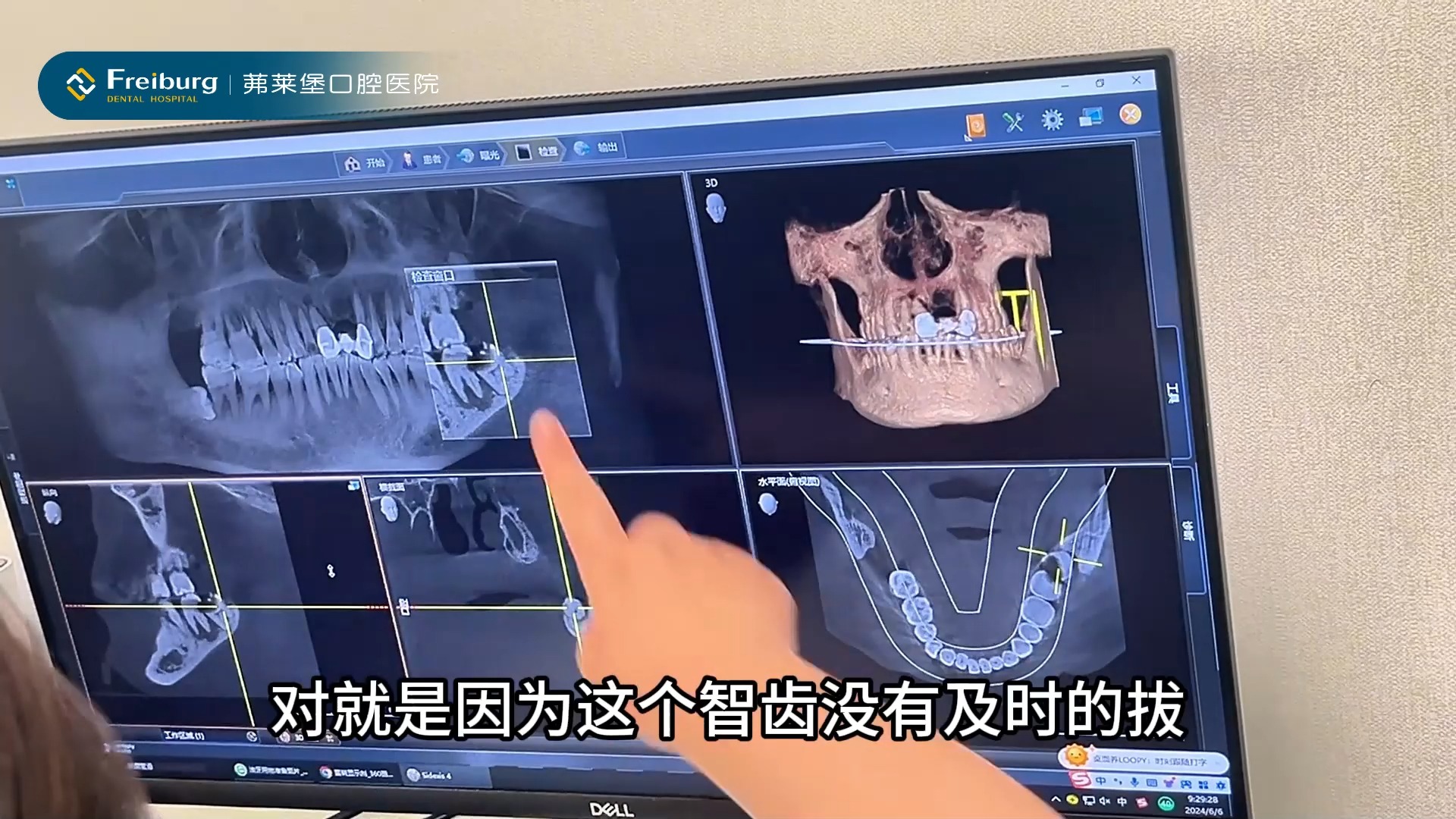 斜着长的智齿如果未及时拔除,也会导致邻牙被顶坏产生炎症哔哩哔哩bilibili