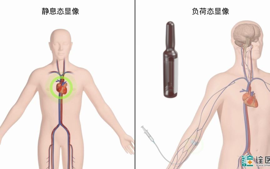 心肌灌注显像检查哔哩哔哩bilibili