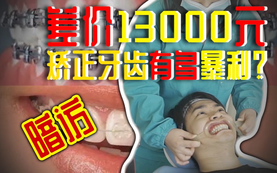 UP主暗访牙齿矫正行业有多暴利?价格差距竟然高达13000元??哔哩哔哩bilibili