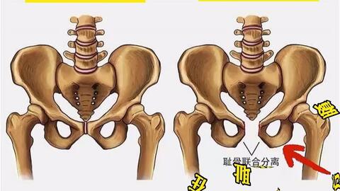 每日一肌 耻骨肌 大腿根疼痛 慢性盆腔痛 还会导致x型腿的肌肉 哔哩哔哩