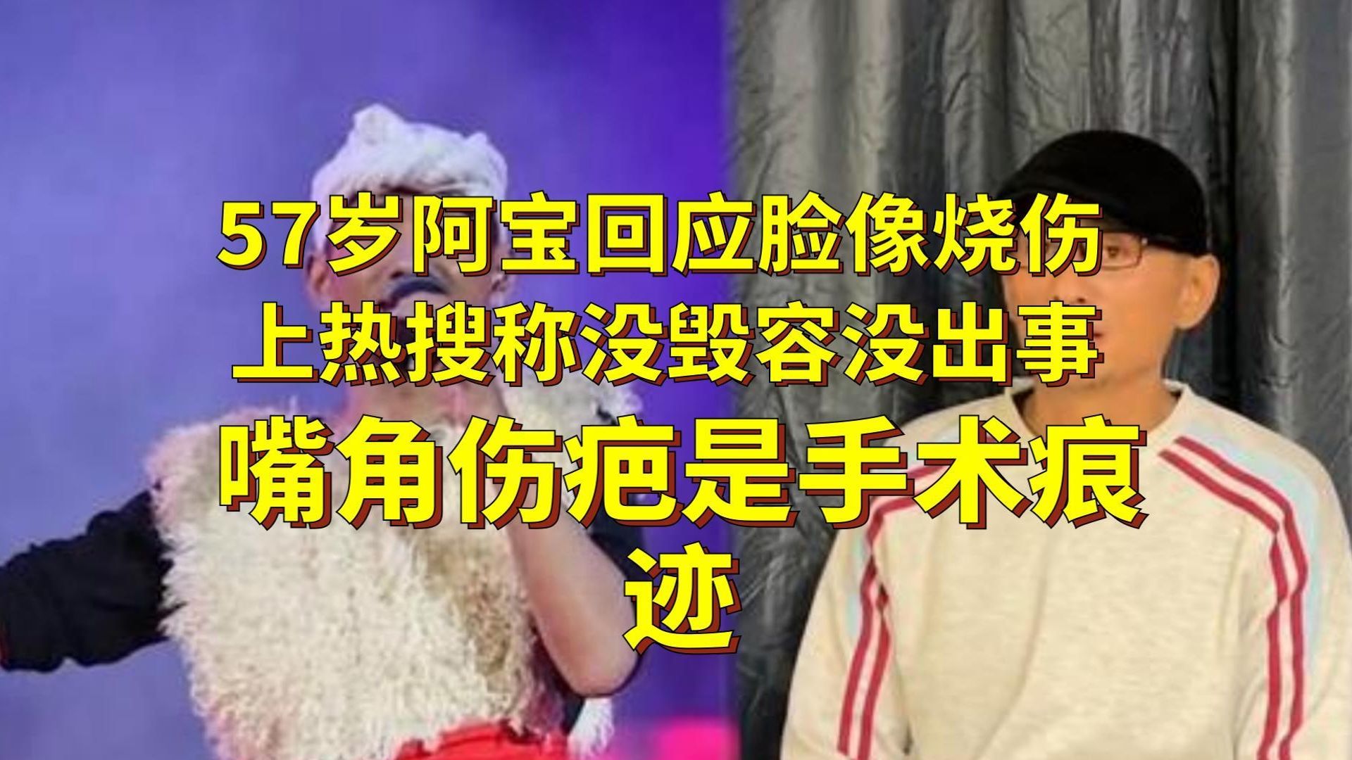 57岁阿宝回应脸像烧伤上热搜，称没毁容没出事，嘴角伤疤是手术痕迹