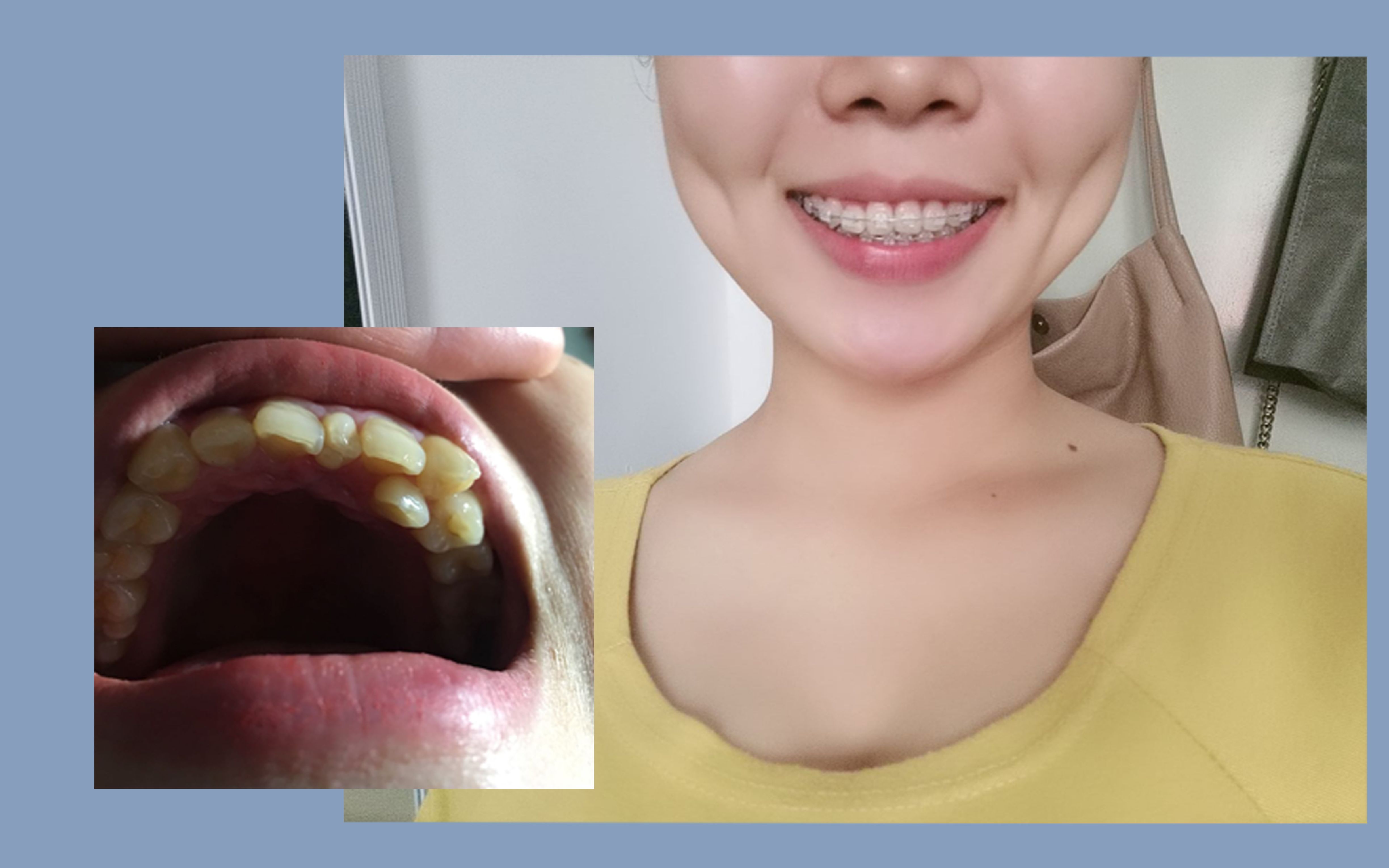 丨正畸后的变化,我也有整齐的牙齿啦!