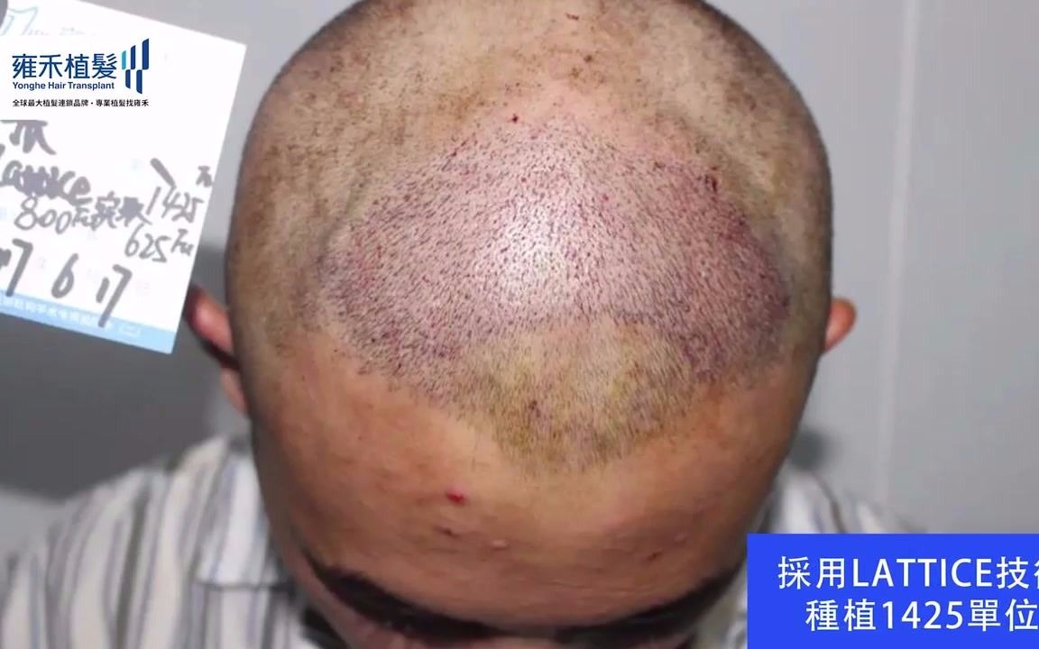 [图]植髮後人的變化可以有多大？藝術生靚仔的植髮日記Yonghe hair transplant