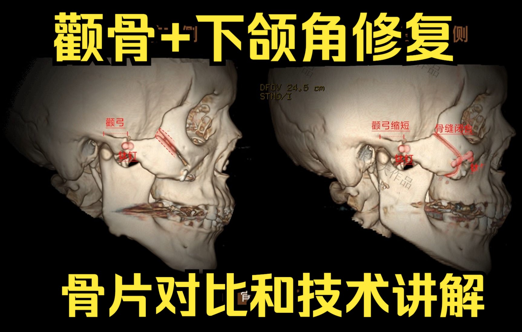 【颌面医生张立天】颧骨+下颌角修复 骨片前后对比和技术讲解哔哩哔哩bilibili