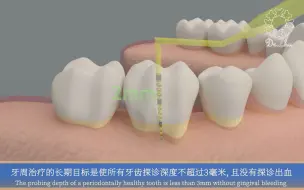 Video herunterladen: 牙周炎治疗（基础治疗与维护治疗）