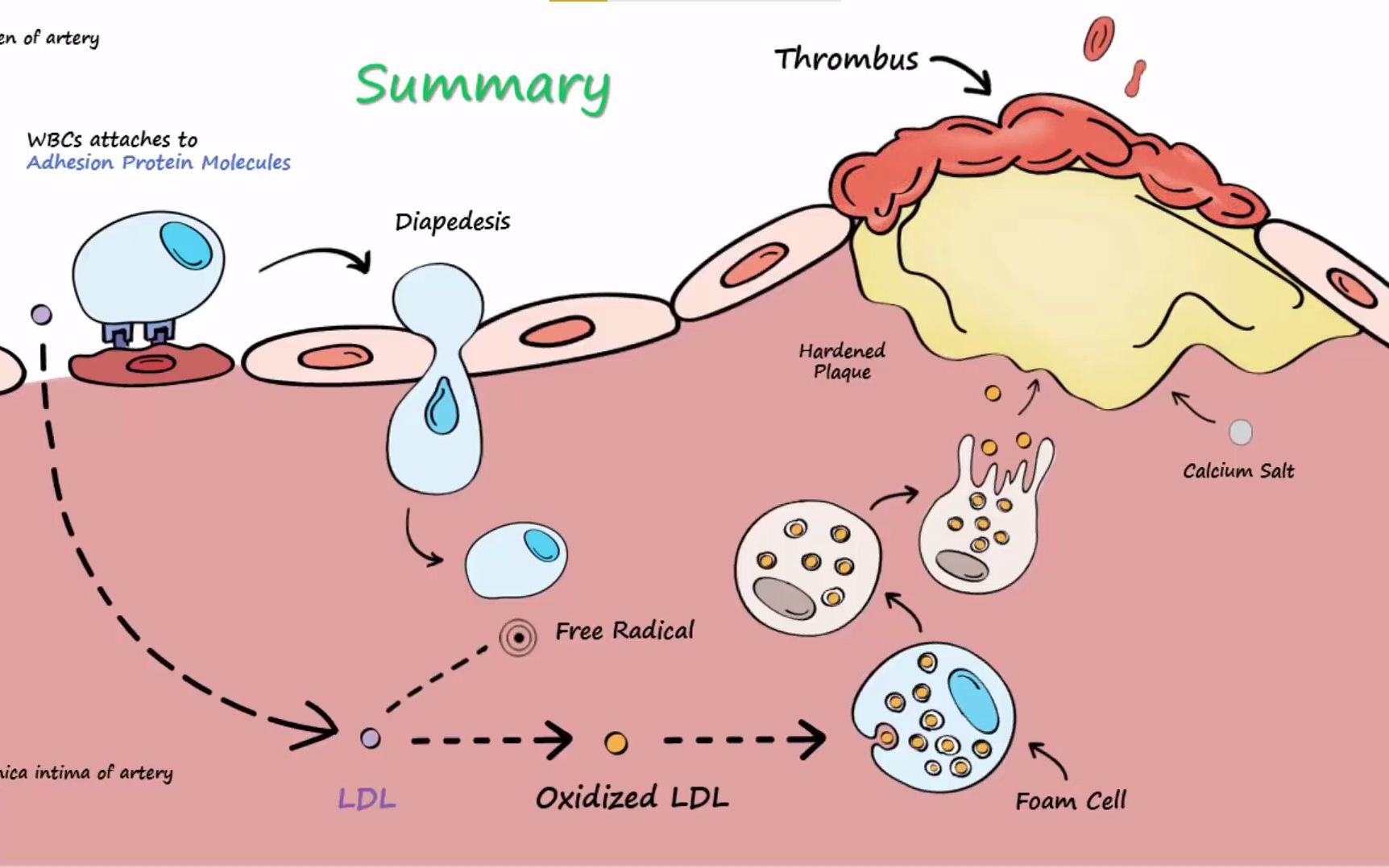 [英文字幕] 动脉粥样硬化是什么?What is atherosclerosis?哔哩哔哩bilibili