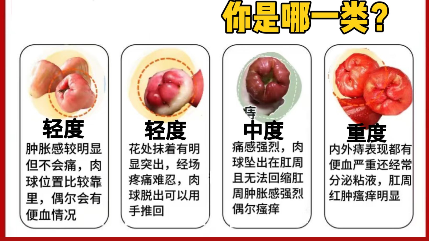痔疮类型自测！来看看你是哪种痔疮？？该怎么解决？