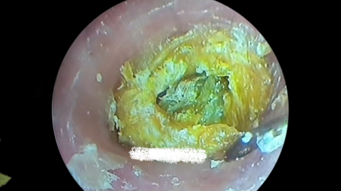采耳解压;好大一坨耳屎把整个耳道堵的严严实实,严重影响听力了