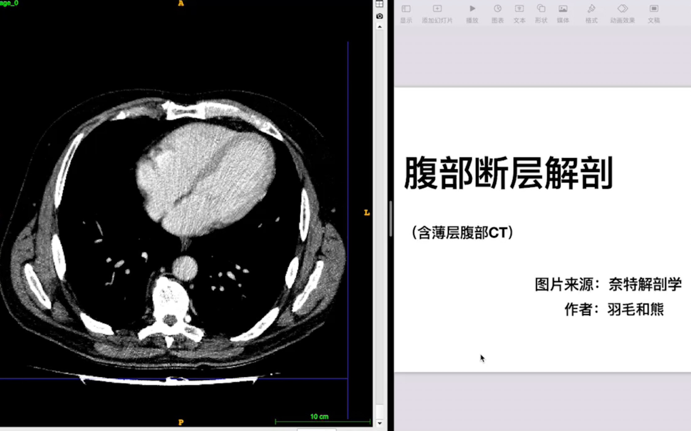 [图]详细分解腹部断层解剖（下）腹部CT血管