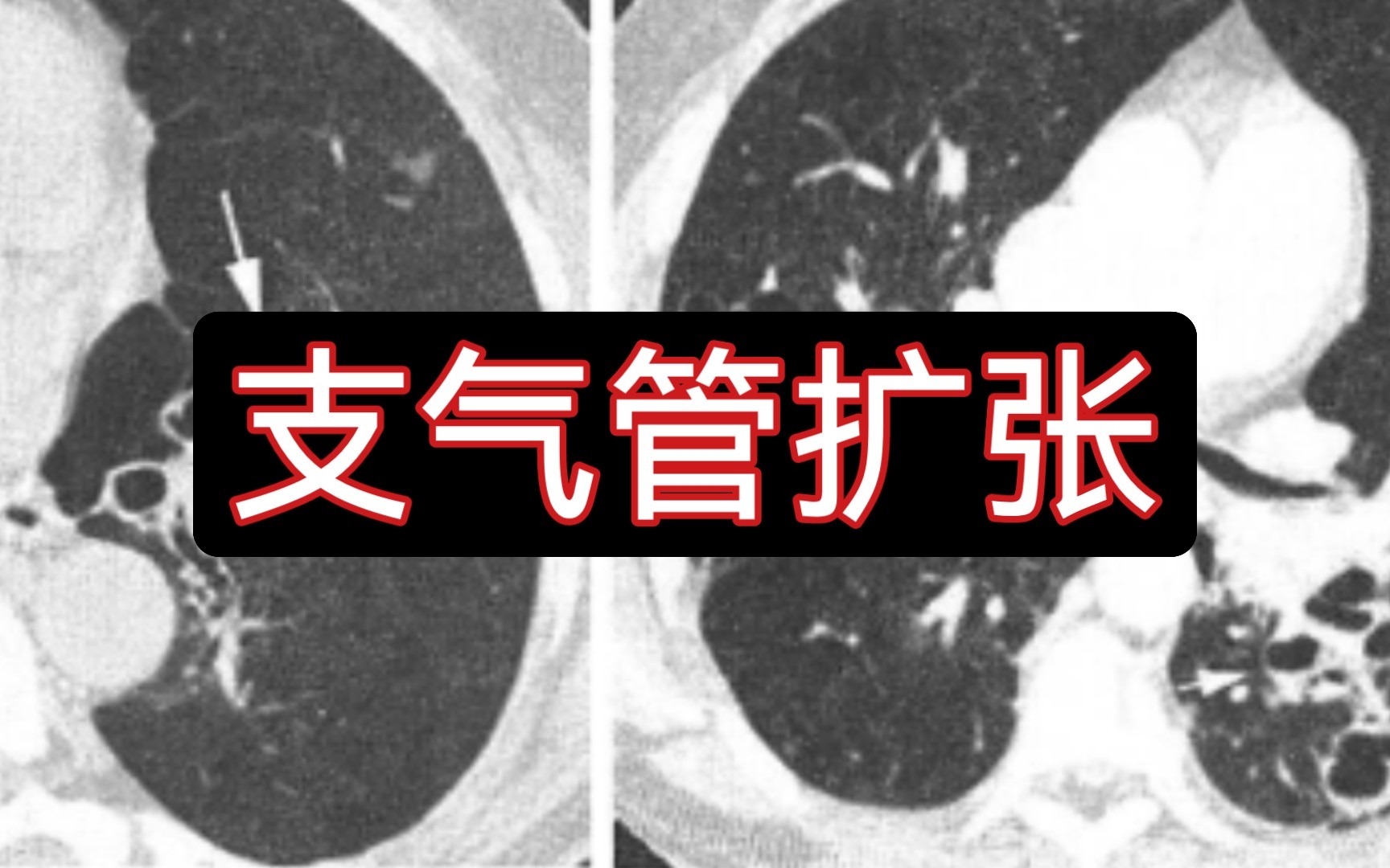 【医学影像】跟我一起刷病例 | 支气管扩张哔哩哔哩bilibili