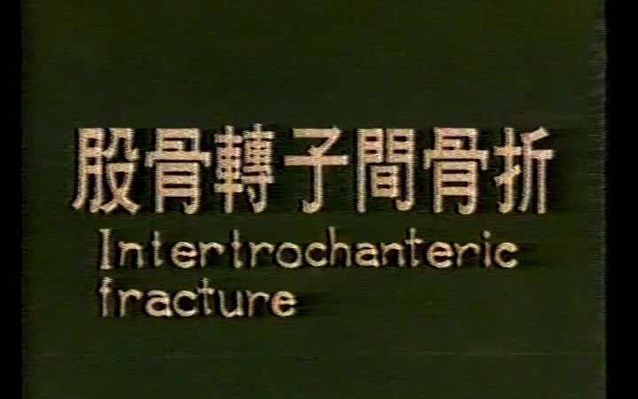 粗隆间骨折(转子间骨折),剪辑自1994年《中国骨伤学》,添加字幕供中医骨伤爱好者学习哔哩哔哩bilibili