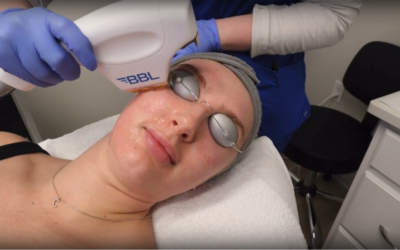 升级版的bbl /bbl plus 光子嫩肤全新体验