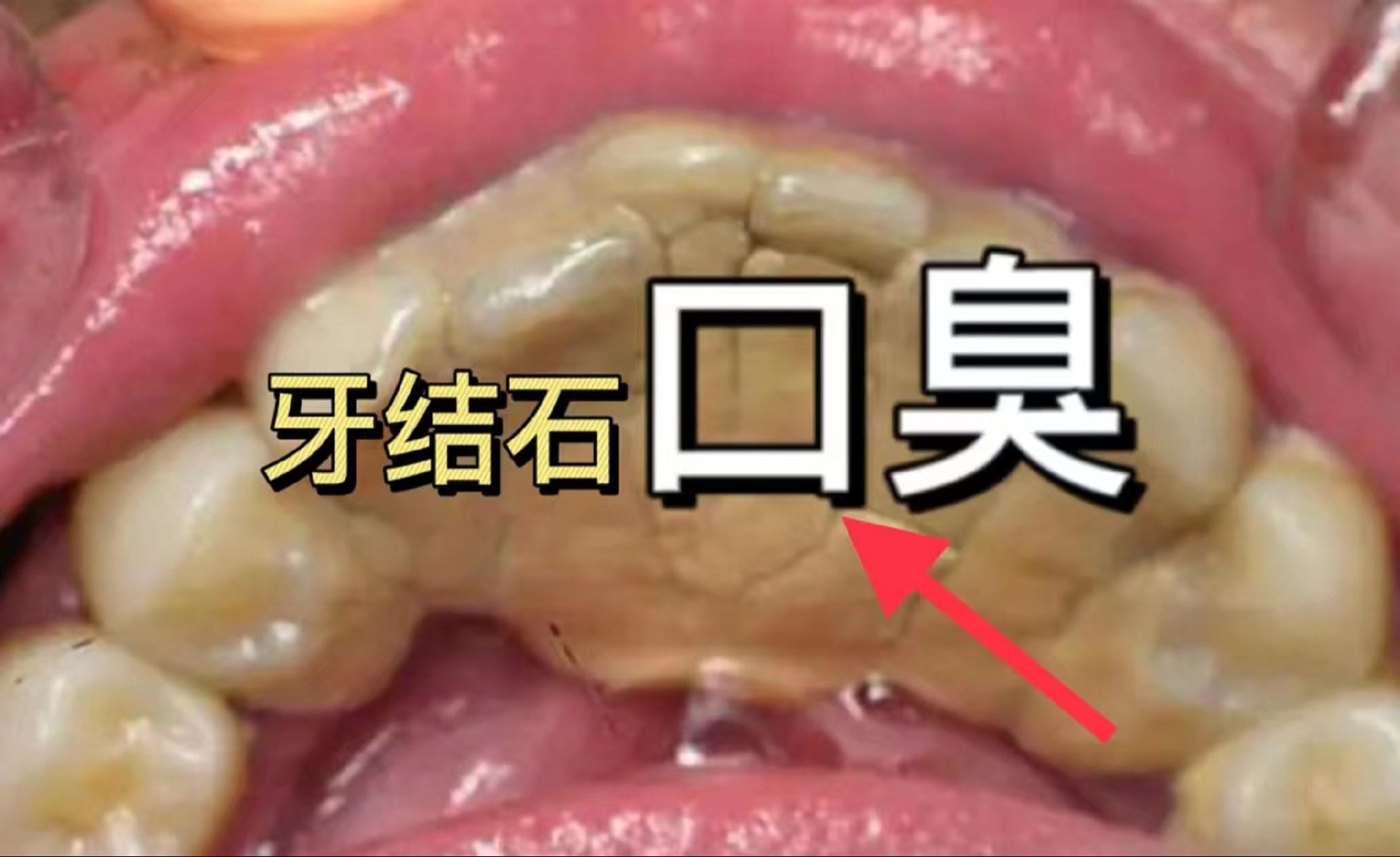牙结石口臭必须知道的三个去除妙招!不想花冤枉钱的赶紧收藏!