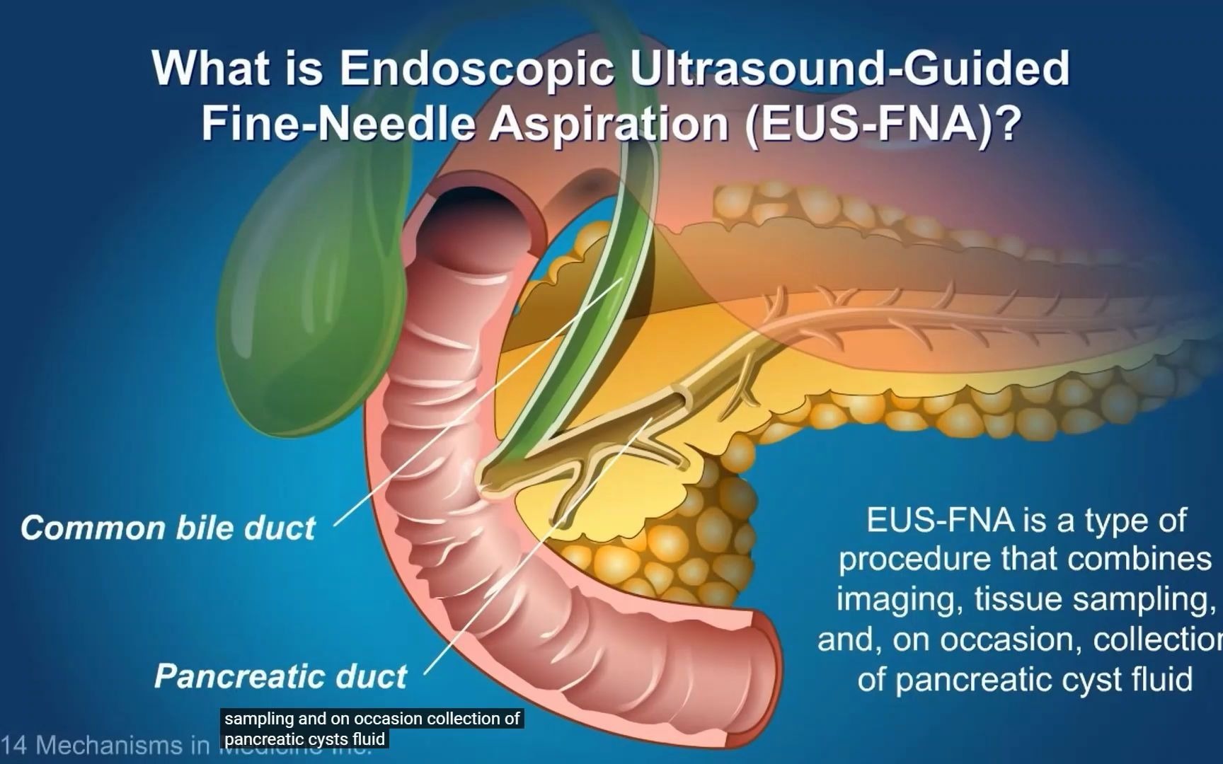 [图]Understanding EUS-FNA