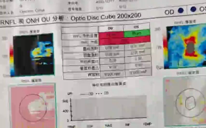 眼科专家复盘艾芬爱尔眼科就诊全程:术前应全面查眼底并告知哔哩哔哩bilibili