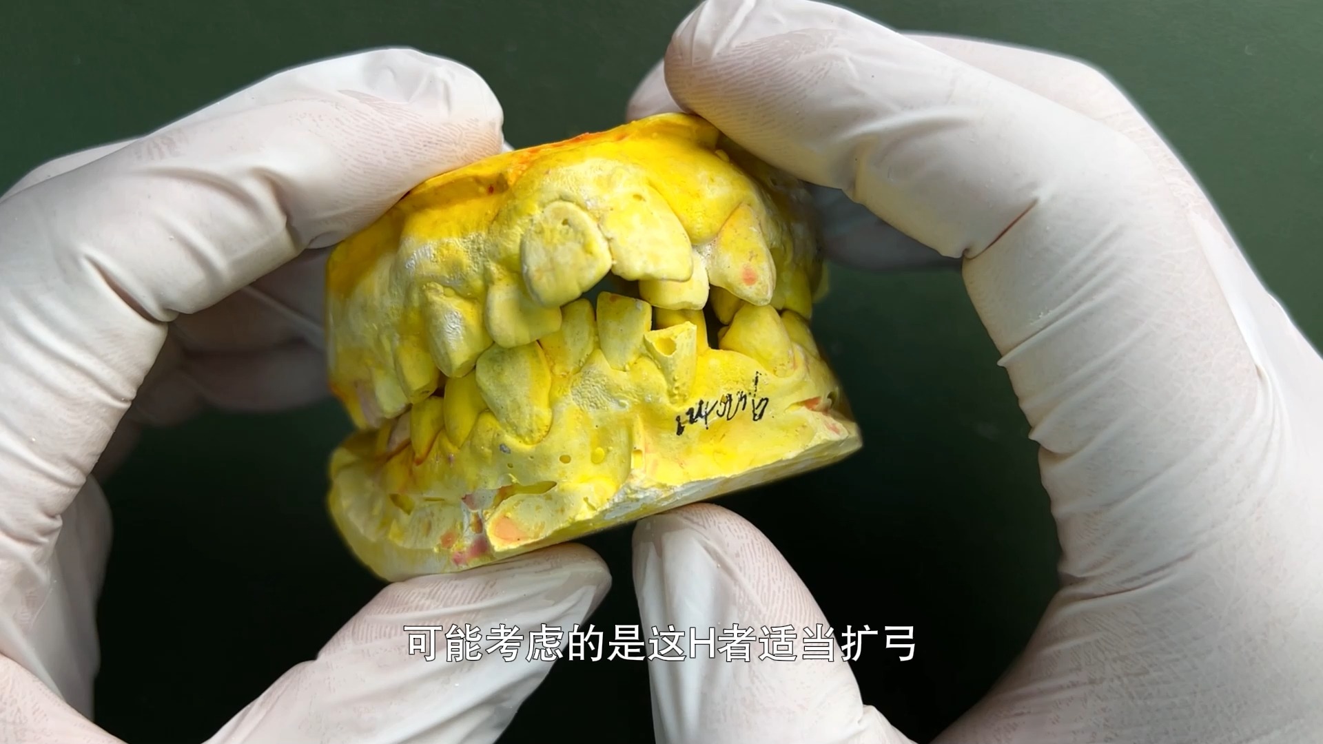固定扇形扩弓器 妃她正畸 儿童牙齿矫正器
