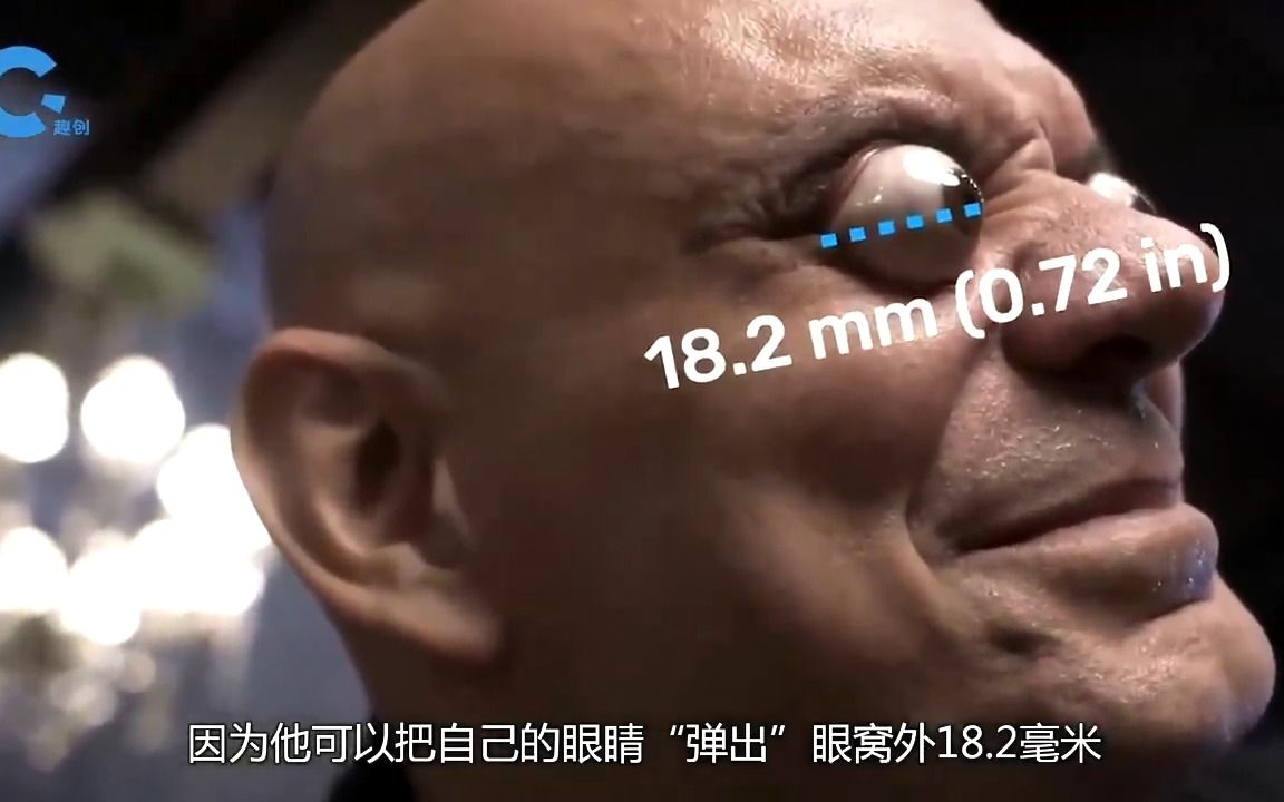 世界上眼球最突出的人图片