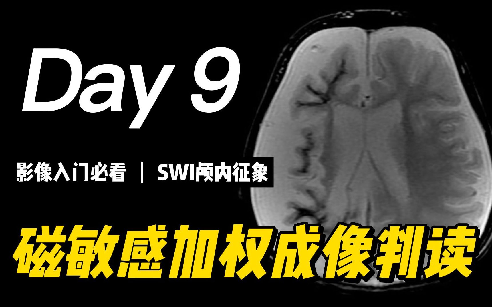 [图]磁敏感加权成像：颅内征象判读 | SWI、血管扩张征、点片征、弥漫点征、弥漫细线征、磁敏感环征、核磁共振成像、医学影像学、放射科、影像医学与核医学、临床医学