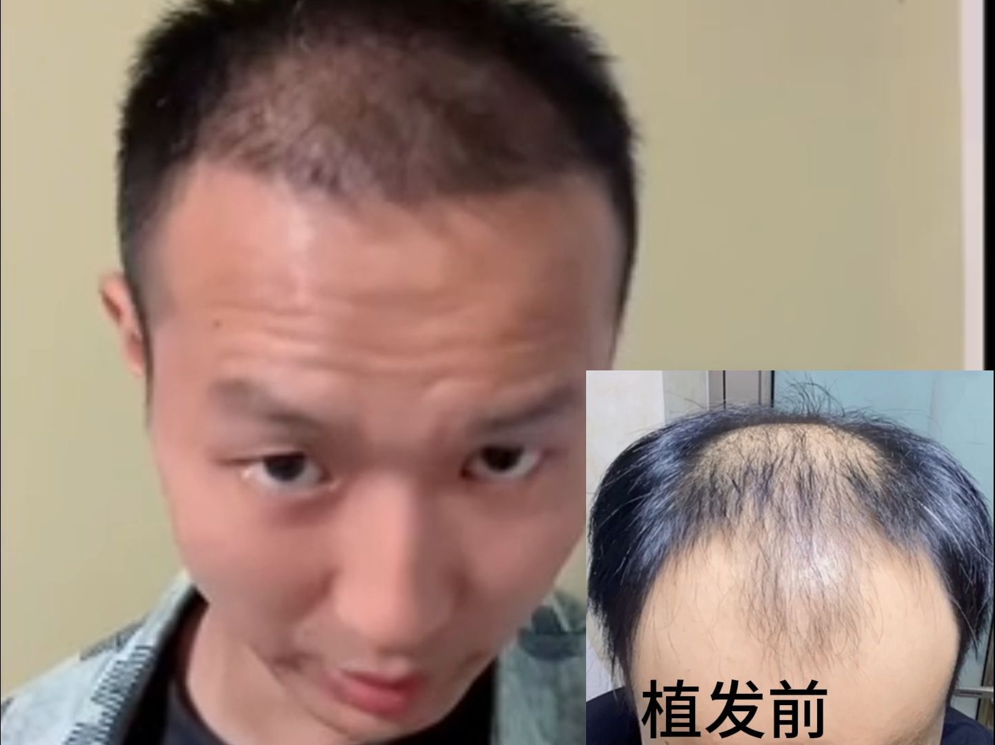 植发多久不吃肉(植发多久不能喝酒)