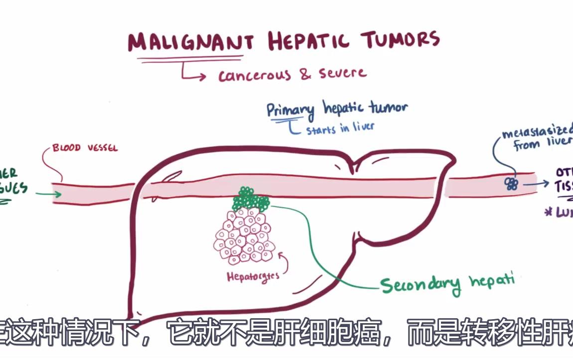 7分钟了解肝癌的病因,诊断,治疗及病理学!哔哩哔哩bilibili