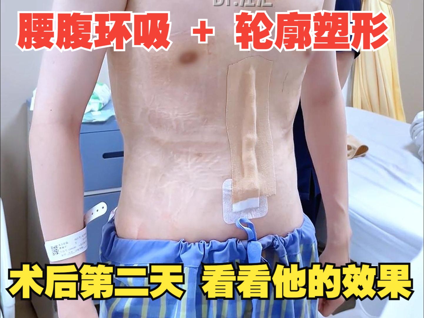 男性腰腹吸脂+腹肌精雕哔哩哔哩bilibili