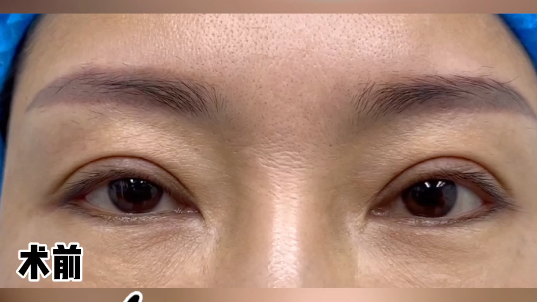 假宽深是很多求美者的问题双眼皮修复快手审美科普合肥双眼皮修复