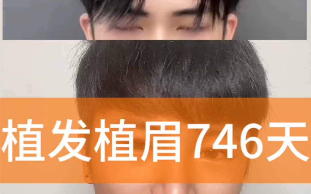 潮州植眉植发(潮州植眉植发哪里好)
