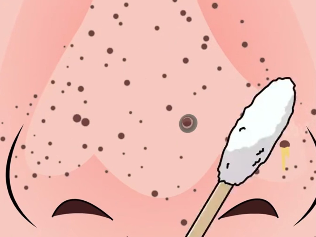 你的黑头是不算也这么乱处理的?