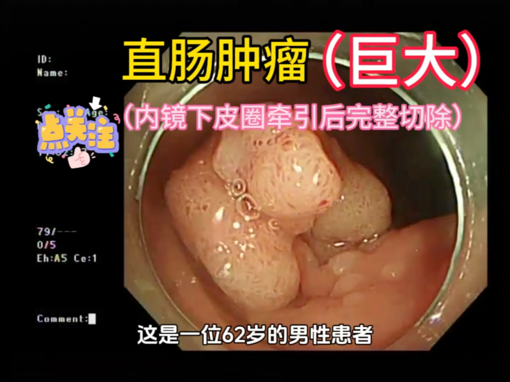 ,内镜下微创切除,该患者全结肠10余枚腺瘤,其中2枚提示