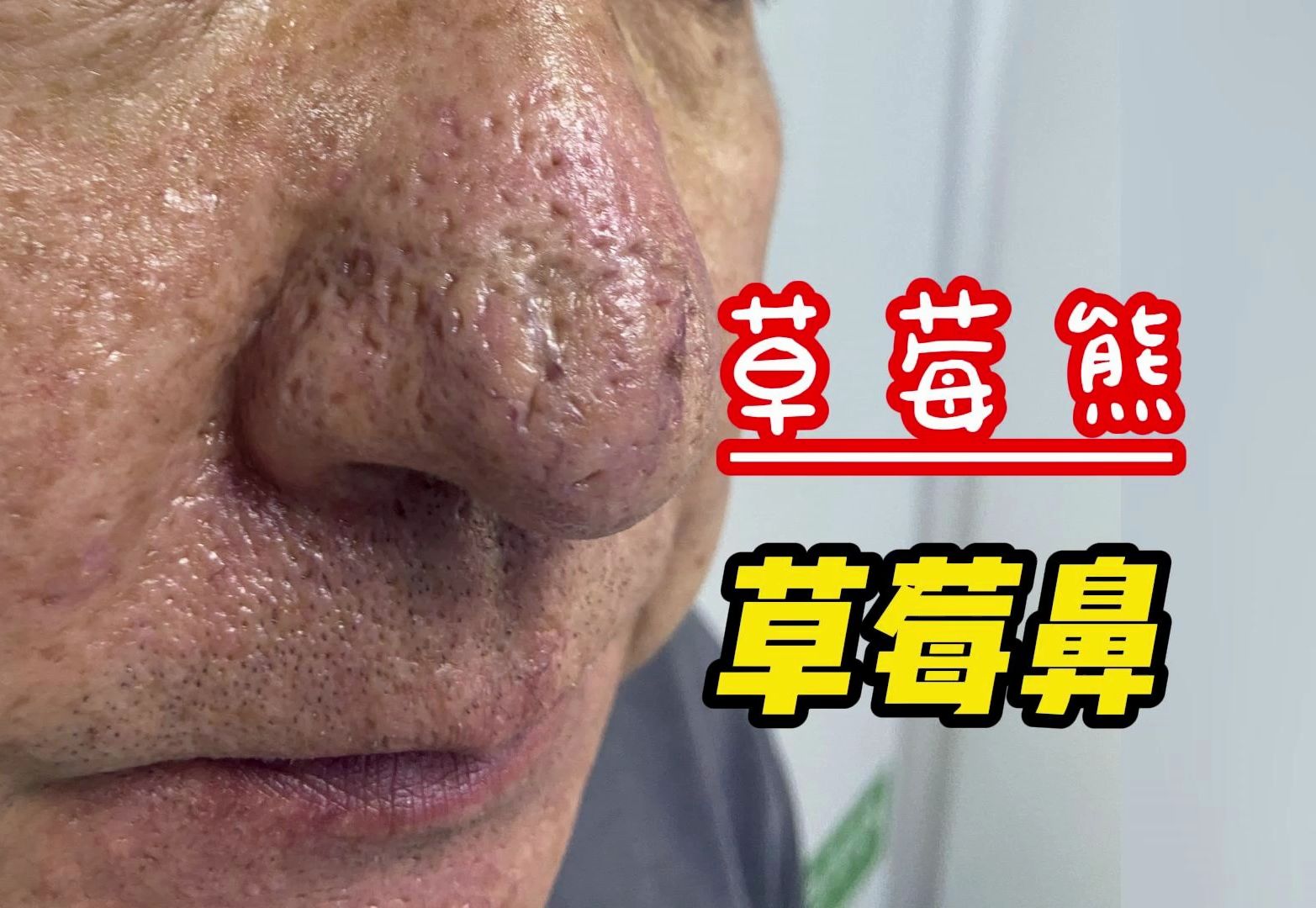 大爷的草莓鼻也算是有救了.