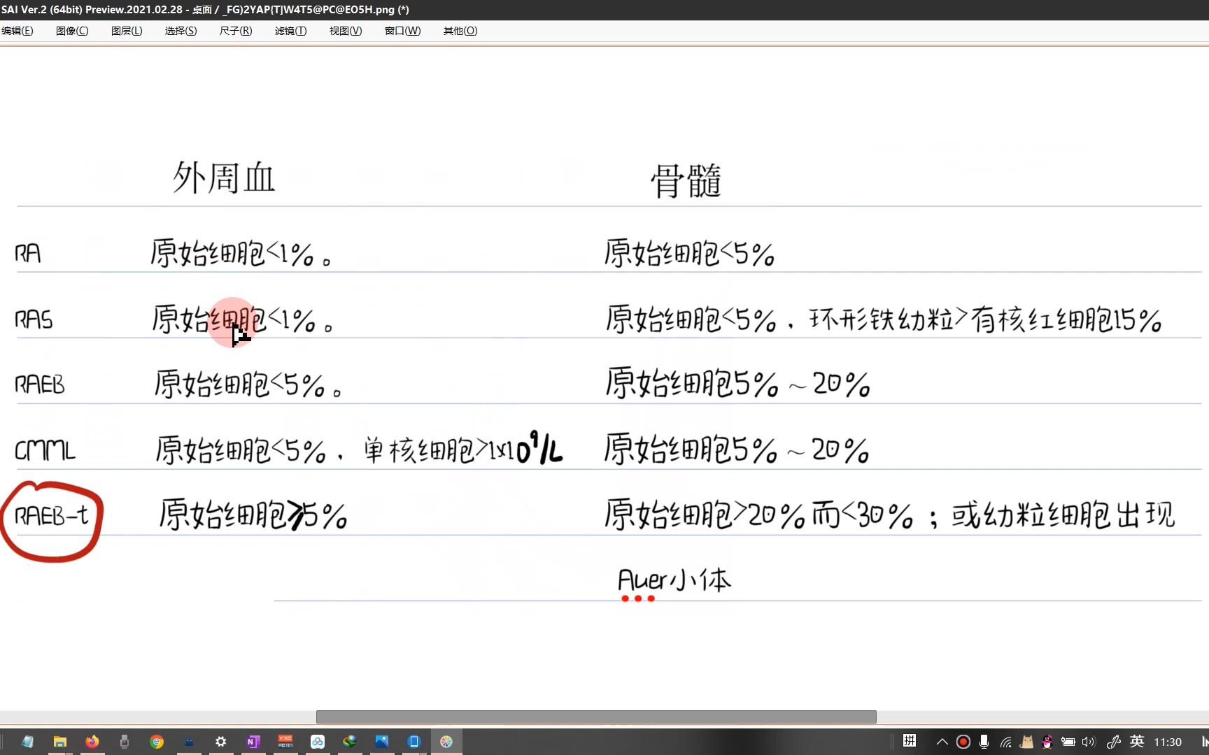 MDS(骨髓增生异常综合征)的FAB分型哔哩哔哩bilibili