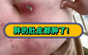 Descargar video: 超级肥胖，合并二型呼衰，人都迷糊了，看看她的肚皮，都肿到了肚脐水平！