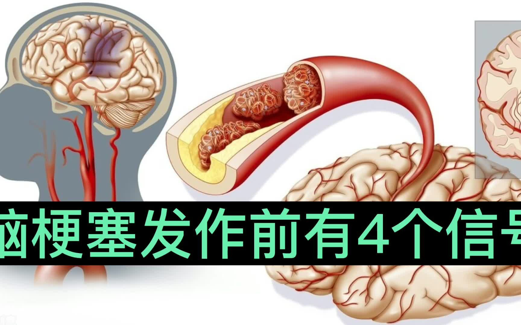 脑梗发作有预兆吗?出现这4个表现,脑梗可能要来了,要警惕!