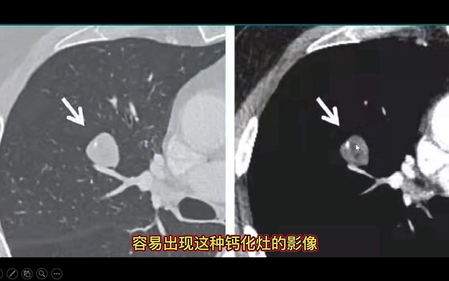 [图]肺部良性结节在CT上什么表现？分享一例典型良性病变，收藏学习