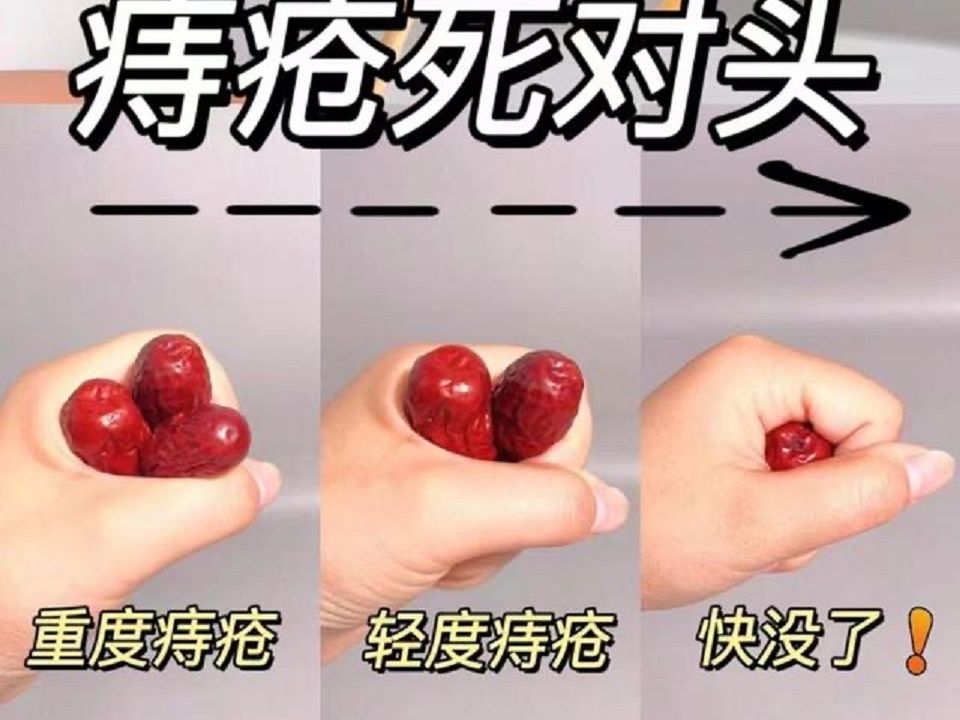 这个东西是除痔天花板!成片肉球一次消除不再长!