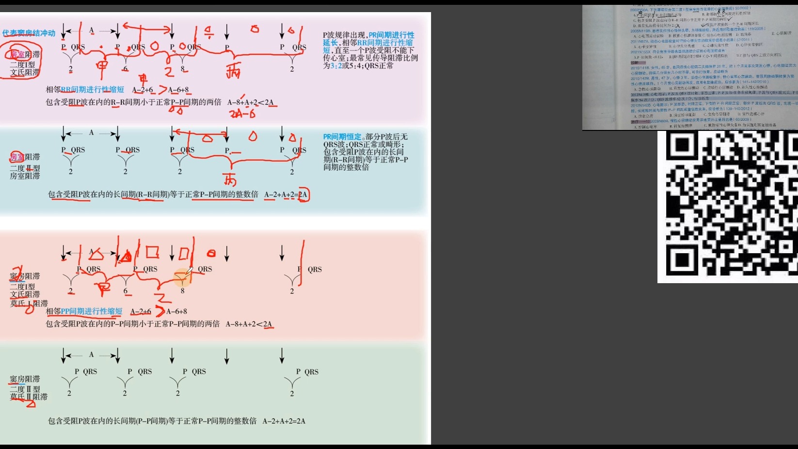 内科学难点——房室传导阻滞和窦房传导阻滞二度一型和二度二型文氏阻滞和莫氏阻滞PP间期RR间期进行性缩短哔哩哔哩bilibili