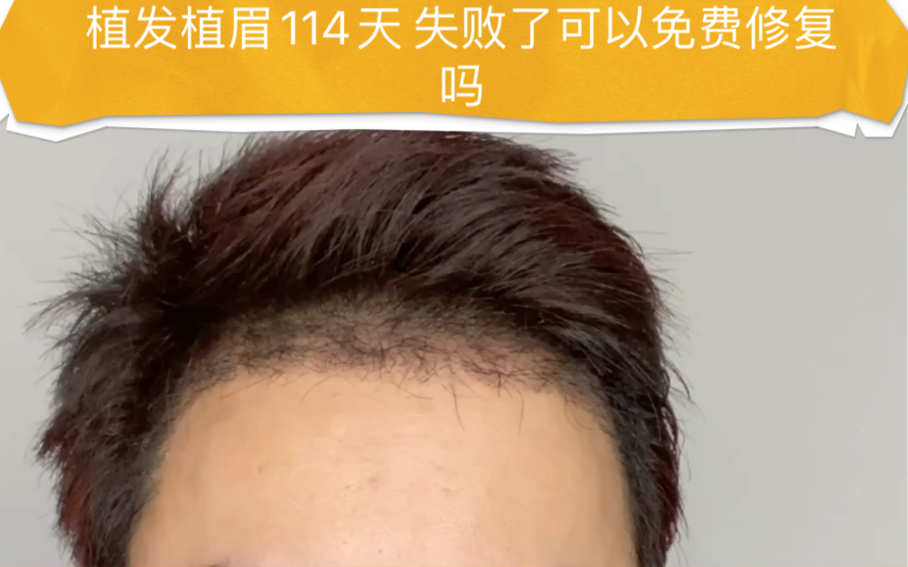 植发植眉术后114天,失败了可以免费修复吗