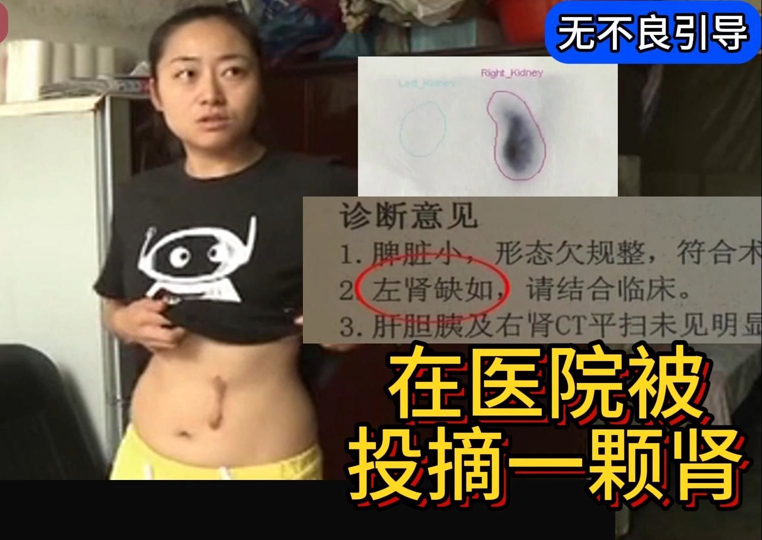 女孩去医院体检,发现丢了一颗肾.怀疑被手术医生摘掉卖钱.哔哩哔哩bilibili