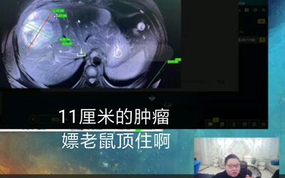 pdd三亚归来 直播给观众看体内肿瘤 还是希望嫖老师能健健康康的 英雄