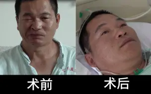 下载视频: 面肌痉挛术后见证奇迹的时刻！