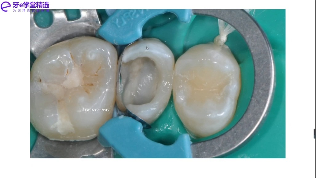 马小寒纤维桩+全冠修复02 前磨牙纤维桩修复之单桩or多桩的选择与粘结流程哔哩哔哩bilibili