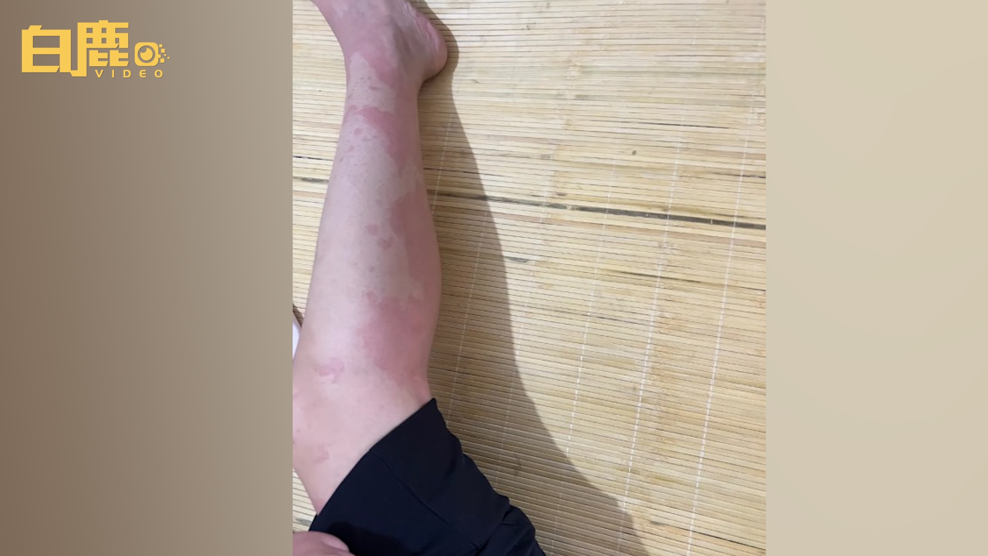 女子食用龙虾味薯片全身过敏_哔哩哔哩_bilibili