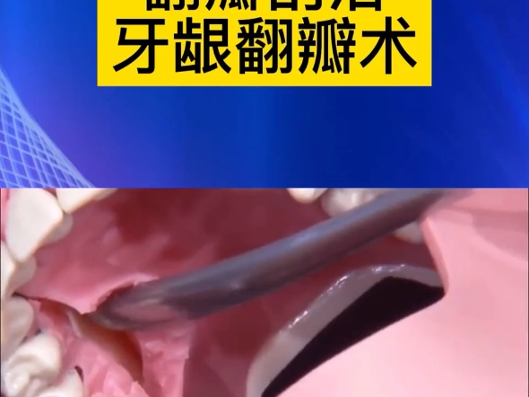 牙龈翻瓣术,是看着有点吓人哈