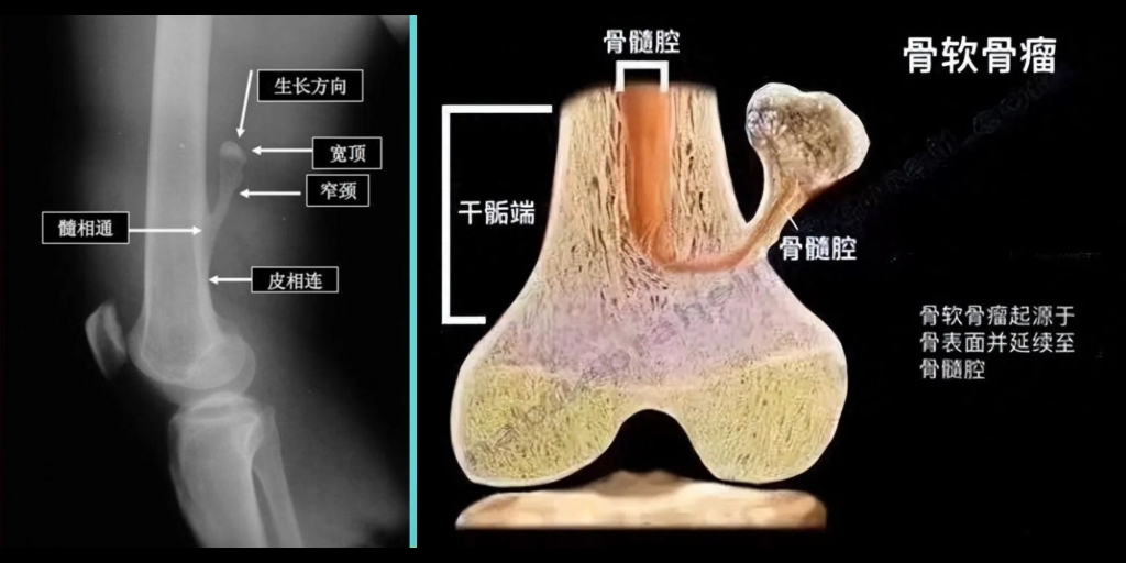 骨软骨瘤示意图.哔哩哔哩bilibili