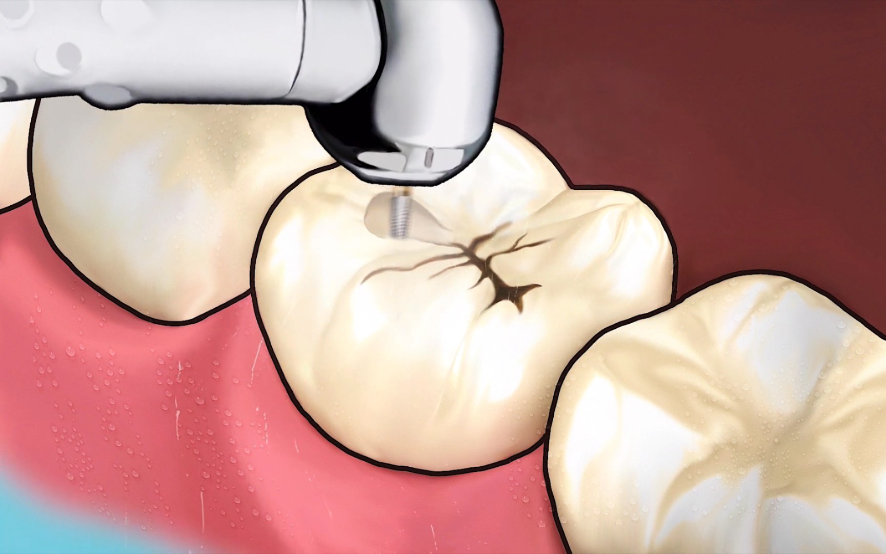 【补牙动画】补牙的酸爽谁懂?绝对解压又助眠!_哔哩哔哩_bilibili