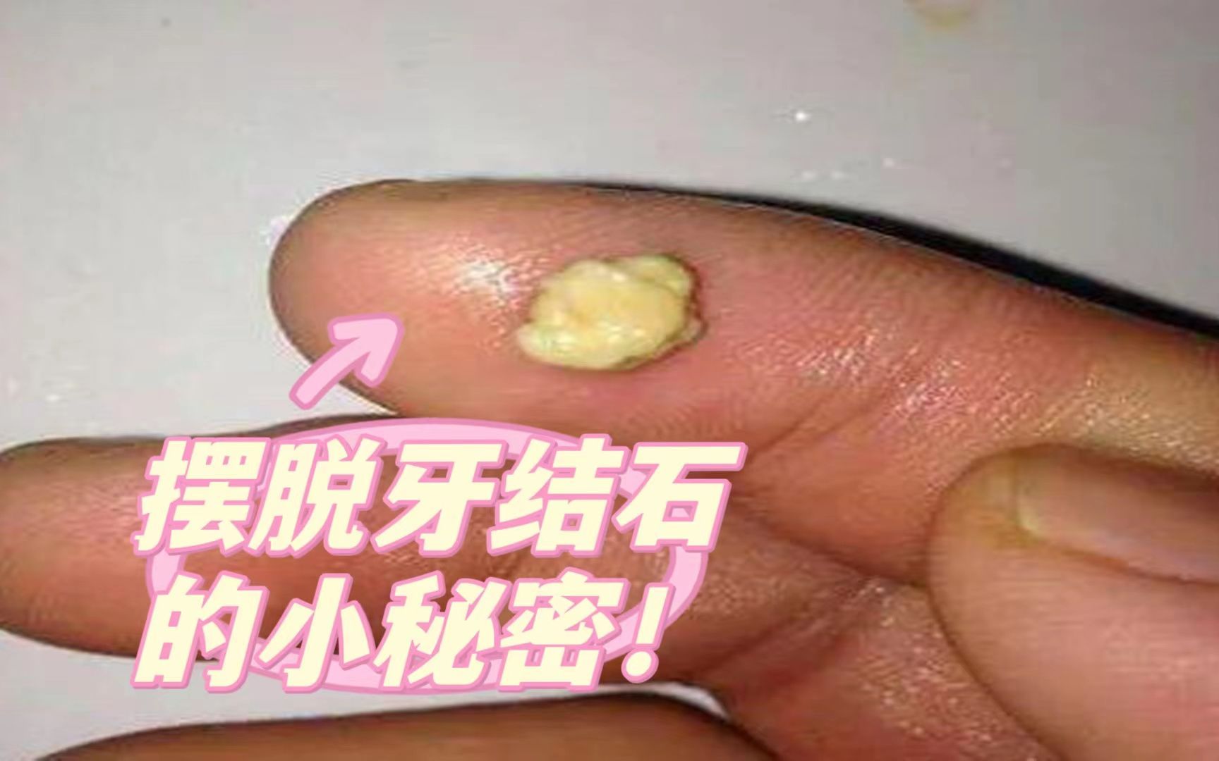 牙齿上的石头如何清除?过来人方法操作一个月,牙石一碰就掉!