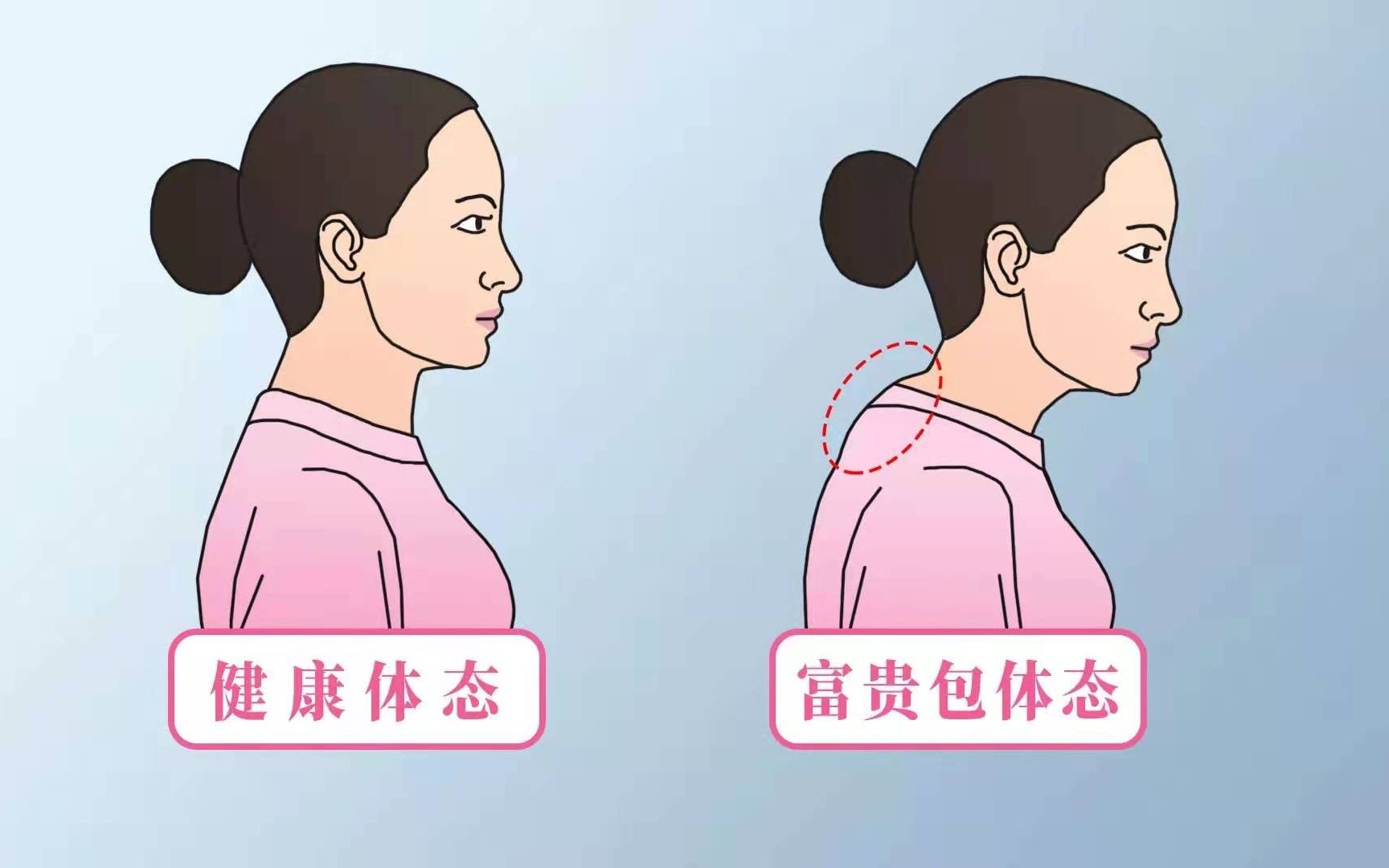 怎样消除富贵包