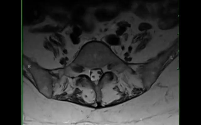 124 (CharcotMarieTooth病,腓骨肌萎缩症)Charcot Marie Tooth Disease哔哩哔哩bilibili