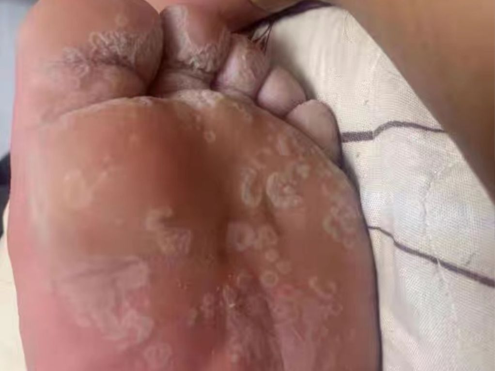 脚底发白发痒终于有救了!做好这四个步骤,脚底瘙痒异常轻松解决!