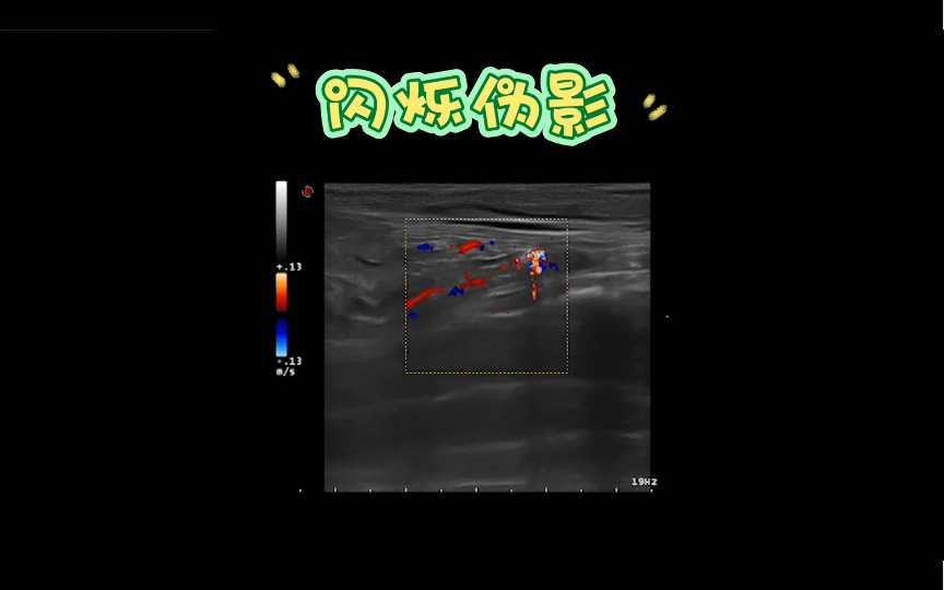 【教科书超声视频】输尿管结石哔哩哔哩bilibili